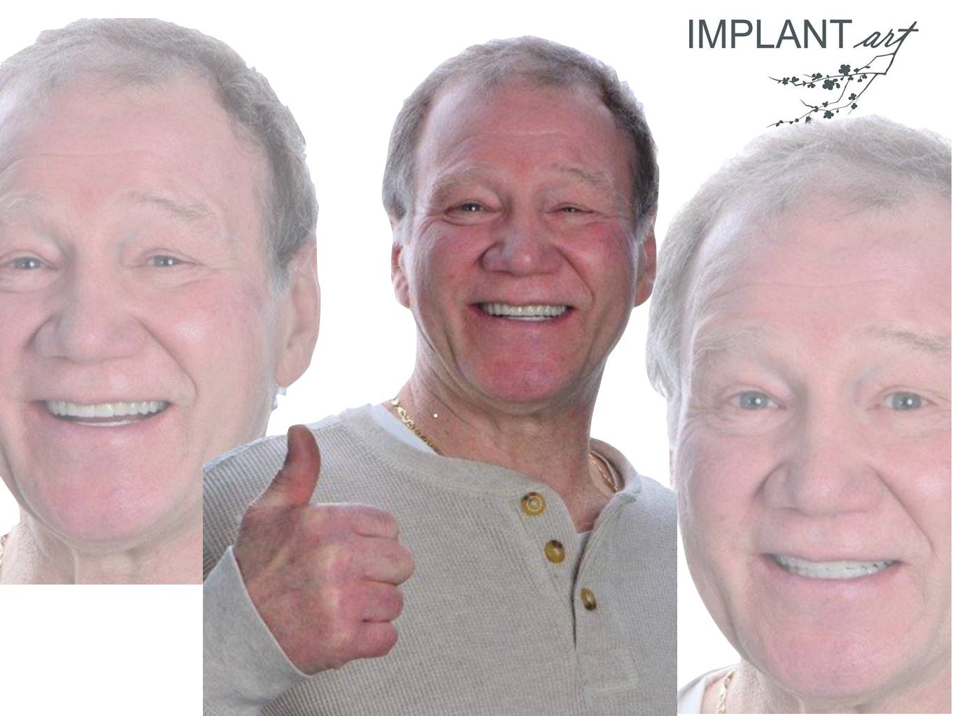 All-ceramic crowns on teeth and implants