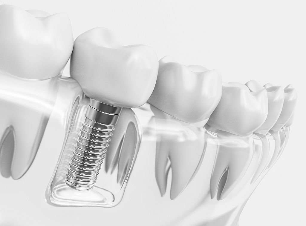 Implanty zębowe: Fakty, które musisz znać